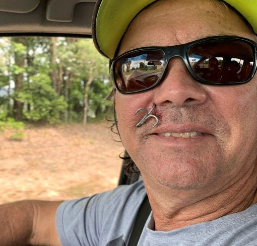 Fish hook accidents - happens to the best of them!