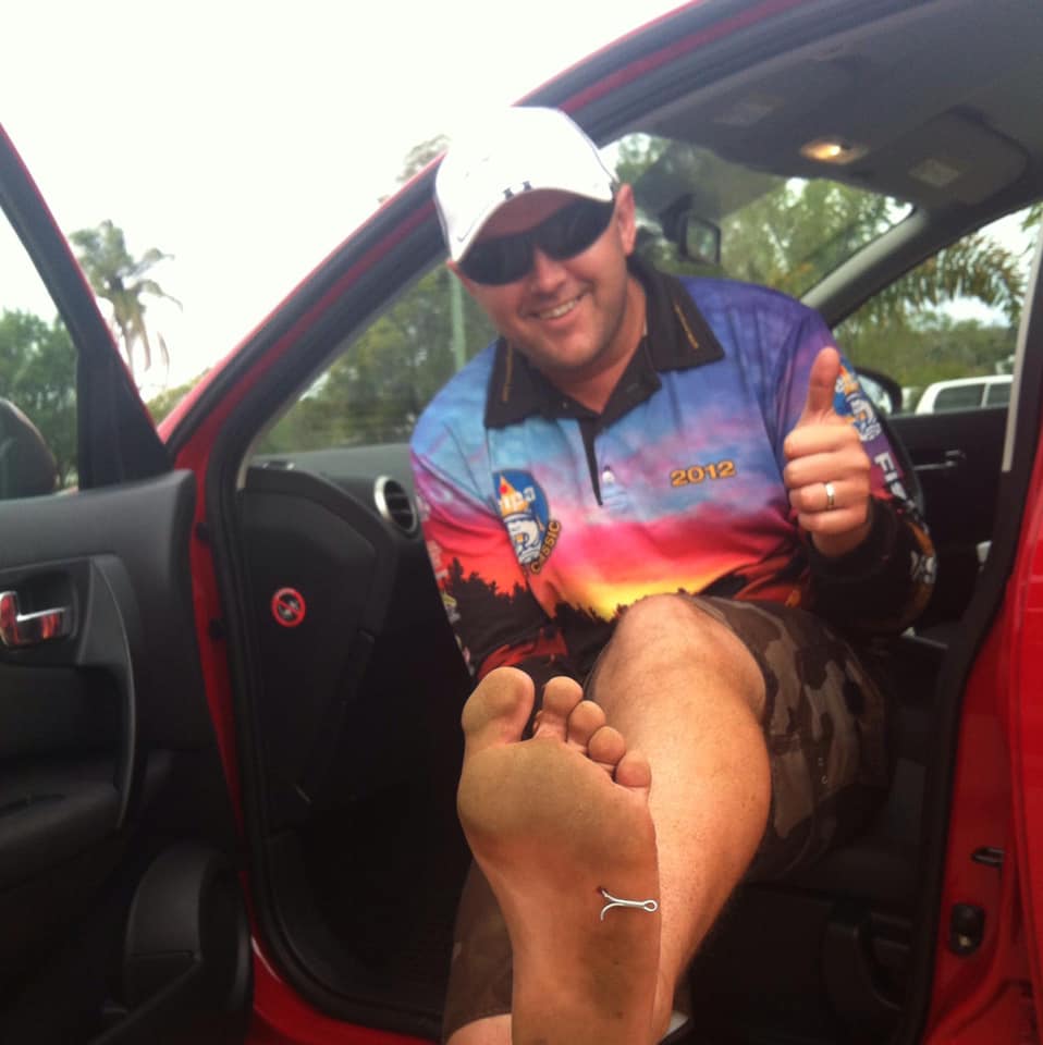 Fish hook in the foot