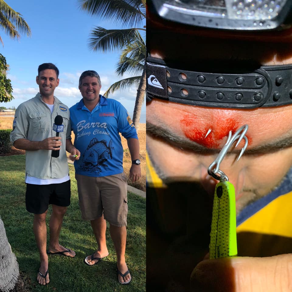 Fish hook accident leads to hook in the forehead requiring removal in hospital.